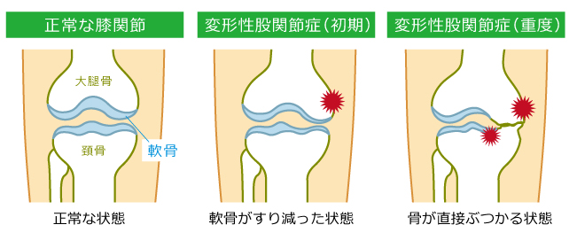 プロテオグリカンが膝の痛みを和らげるメカニズム